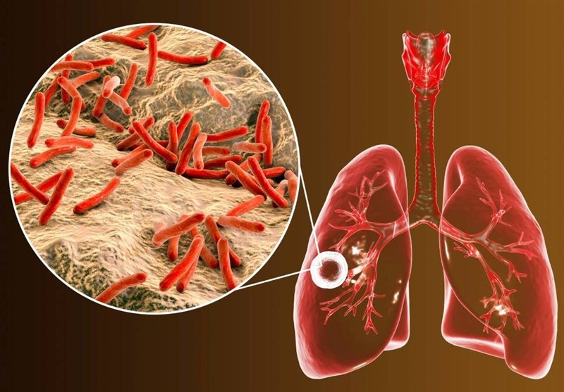 بروز سل در دیابتی‌ها: از هر 4 نفر بیمار مبتلا به سل، یک نفر دیابت دارد